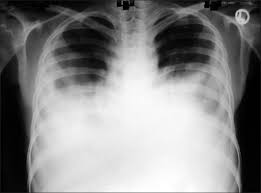 It can result from pneumonia and many other conditions. Chest X Ray Revealed Bilateral Pleural Effusion Open I