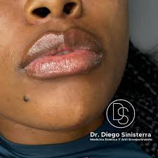 Proyección de mentón y relleno de labios con ácido hialurónico. Resultados  naturales #lipfiller #ÁcidoHialurónico #LabiosPerfectos