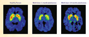 In recent years, the recreational use of methamphetamine has skyrocketed in the united states. What Are The Long Term Effects Of Methamphetamine Misuse National Institute On Drug Abuse Nida