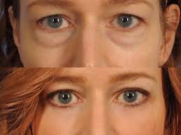 The patient most likely to benefit from cat eye reshaping is one whose eyes tilt slightly downward and/or whose outer lower eyelid contours appear to be sagging. Female Upper Lower Eyelid Lift Before After Close Up Eyelid Lift Eye Lift Surgery Body Lift Surgery