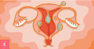 Unfortunately, polyps can be easily mistaken for fibroids because they look similar in imaging tests and they can both cause heavy menstrual bleeding, cramping, and abdominal. The Connection Between Uterine Fibroids And Endometriosis