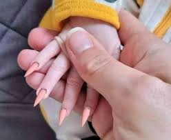 Por suerte, existen tratamientos sencillos y efectivos para este tipo de infecciones. Podologo Sudo La Gota Fria Cortandole Las Unas A Una Descuidada Mujer Alerta Bogota