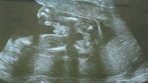 Immerhin wollen die ärzte ein klares bild. Schwangerschaft Entwicklung Im Ultraschall Netdoktor At