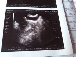 Pruebas Positivas Quistes O Embarazo Embarazadas Primerizas Babycenter