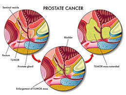 Prostate cancer may cause no signs or symptoms in its early stages. Cancer Types Prostate Cancer Baltimore Md Advanced Diagnosis And Treatment For A Wide Range Of Cancers