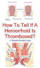 Pin On Internal Hemorrhoids