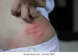 Image result for spinne biss haut reaktion