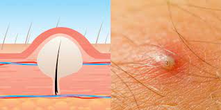 I think i have an ingrown hair. Everything You Need To Know About Ingrown Hairs Self