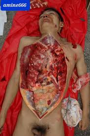 Autopsy of young Chinese man stabbed to death | theYNC