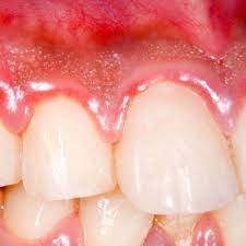 Gingivitis La Inflamacion De Las Encias