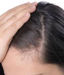 3 small natural hair growth oil for alopecia, thinning, bald spots, and thin edges (can be used on natural hair and relaxed hair) beautybyahmari. Thinning Hair It Might Be Female Pattern Baldness Dr Batra S