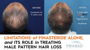 Basically, finasteride reduces the amount of dht produced and allows the hair to regrow. Why Finasteride Is Limited In Thickening Thinning Hair And Getting Thicker Hair Beyond Finasteride Youtube