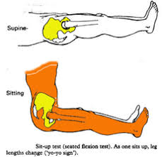 Image result for Pelvic Compression Test
