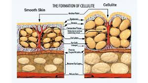 She might use cellfina to release dimples on a patient's buttocks and then inject a. Say Goodbye To Cellulite