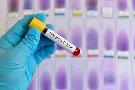 The results usually come back within 2 weeks. What Is Hepatitis C Its Symptoms Causes Tests And Treatments