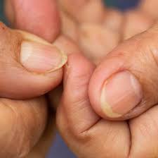 This could cause a lot of pain or it could even be painless. 8 Reasons Your Nails Are Yellow According To Dermatologists