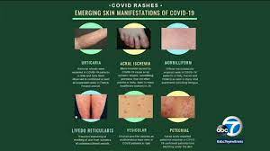 Coronavirus Symptoms Dermatology Organization Issues Guidance On Skin Rashes Associated With Coronavirus Abc7 San Francisco