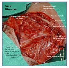 The tumors often start in the mouth and spread to the lymph nodes, which is when they become visible on your neck. Neck Mass Not Every Lump Is A Tumor But It Might Be