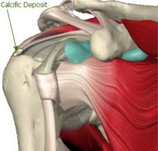 Your shoulder is made up of three bones: Calcific Tendonitis Brisbane Knee And Shoulder Clinic Dr Macgroartybrisbane Knee And Shoulder Clinic