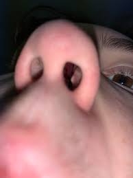 Disease of paranasal sinuse, bacterial infection, nasal vestibulitis symbol. Hey R Popping Community I Was Hoping For Some Advice For How To Treat This Figured This Is The Best Place To Ask Popping