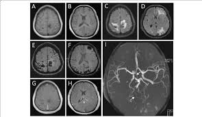 These checks are usually done with a magnetic resonance imaging (mri) scan. Mri Brain Images Show Multiple Brain Metastases Of Myxoma Hemorrhage Download Scientific Diagram
