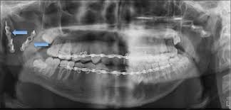 Image result for Coronoid Process Fracture