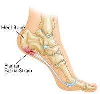 Home Remedies For Plantar Fasciitis Plantar Fasciitis Plantar Fasciitis Treatment Health And Nutrition