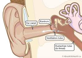 Babies can get ear infections with nasal congestion, a cold, allergies or when around smoking. Myringotomy And Ear Tubes Care At Home After The Procedure