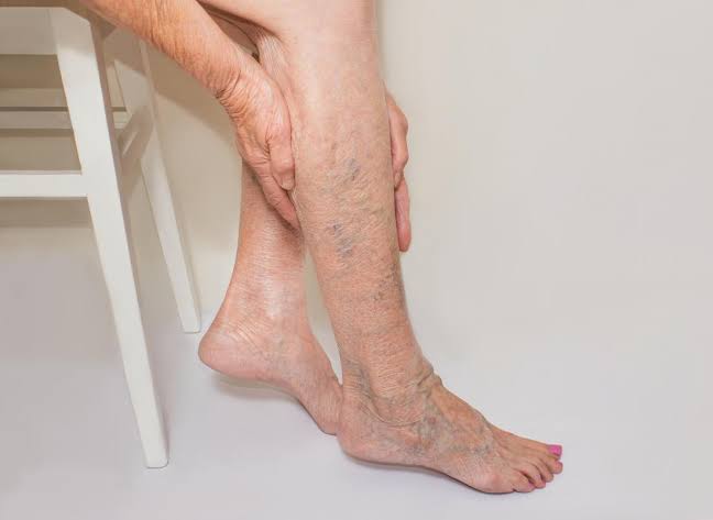 Image result for varicose veins"