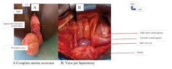 Image result for Uterine Inversion