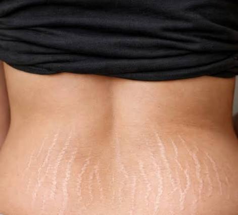 Stretch mark treatment consultation at Profrea