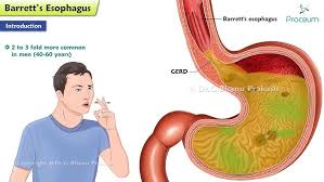 Image result for esophagus