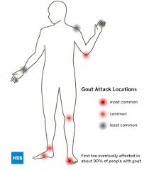 Image result for gout