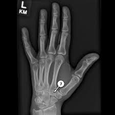 Image result for Trapezoid Bone