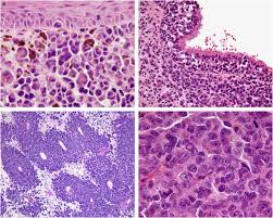 A mnemonic for a short list of diaphyseal lesions is: Small Round Blue Cell Tumors Of The Sinonasal Tract A Differential Diagnosis Approach Modern Pathology