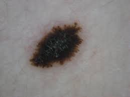 Image result for Spitz Nevus