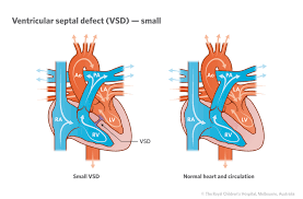 Image result for Ventricular Septal Defect