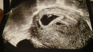 Ultraschall Hamatom Hilfe 6 3 Forum Schwangerschaft Urbia De