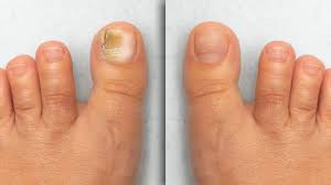 Image result for Pitting nails feet