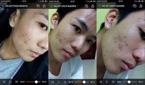Asal Muka Berlubang Lubang Ibarat Jalan Tak Cukup Turap Kini Hensem Tampan Bergaya Tanpa Perlu Bazir Ribu Riban Ini Tips Dari Beliau Siakap Keli News