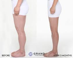 Calf Reduction Thigh Liposuction Plastic Surgery Procedures Plastic Surgery Korea