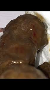 Image result for blood in stool human poop