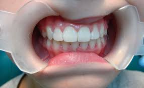 Kedua, partikel di atmosfer bumi; Pendakap Berwarna Warni Band Getah Berwarna Pada Pendakap Clarity Sl Braces