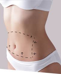 Image result for Liposuction