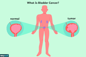 Bladder cancer is easier to treat when it's caught early, according to the aua. Coping With Bladder Cancer