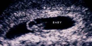 A dating scan may be performed from 6 weeks of pregnancy, with the optimal time being 8 weeks. An Early Dating Viability Scan In Early Pregnancy