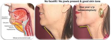Facelift (Cervicofacial Rhytidectomy) Surgery