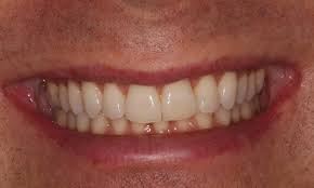 「" 	 crowding」的圖片搜尋結果