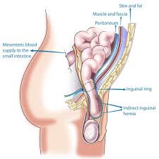 Image result for Inguinal hernia man