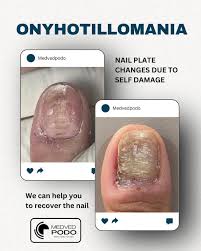 Image result for Onychotillomania feet